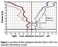 The normal ranges of selected acoustic rhinometry parameters depending on age and sex-component of standarization in nasal provocation test