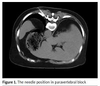 The effectiveness of repetitive paravertebral block with
ropivacaine and dexmedetomidine for the prevention
of postherpetic neuralgia in patients with acute herpes
zoster